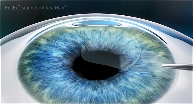 レーザー屈折矯正手術に関するご質問にお答えします